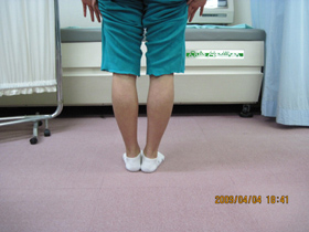 15歳女性 矯正前